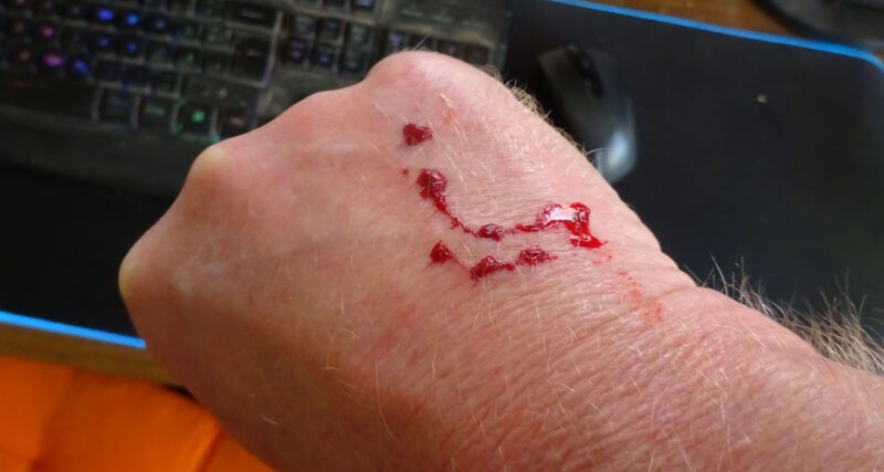 cat injuries to hand